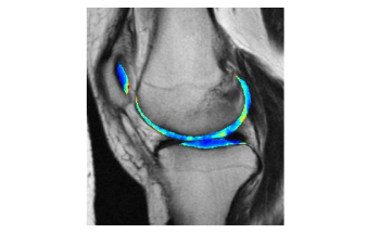 Researchers Develop Machine-Learning Algorithm to Detect Subtle Signs of Osteoarthritis