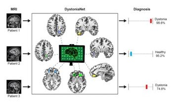 AI Deep Learning Platform Detects Dystonia from MRI Scans