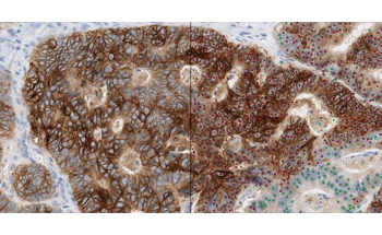 New AI-Based Method Could Enable Better Treatment of Advanced Bowel Cancer
