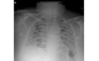 AI Program Quickly Predicts Which Patients with COVID-19 Might have Lethal Complications