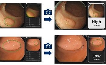 NEC’s Artificial Intelligence (AI) Supports Doctors to Determine If Colorectal Lesions are Potentially Neoplastic