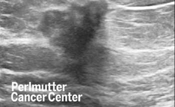 New AI Tool-Based Advancement in Breast Cancer Imaging