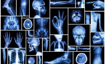 AI can Help Physicians Interpret X-Rays After Injury and Suspected Fracture