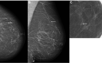 AI Used in Breast Cancer Diagnosis, Likely to Be a Promising Approach