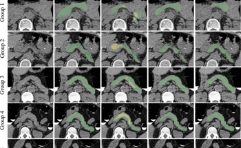 Study Shows How Abdominal CT Imaging Tool Helps to Treat Type 2 Diabetes