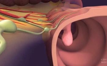 AI Helps Decrease Miss Rate of Precancerous Polyps in Cancer Screening
