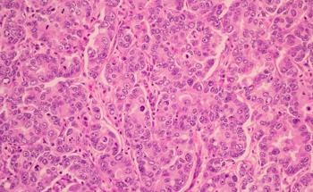 A New Method of Using AI to Predict Cancer from Patient Data Confidentially