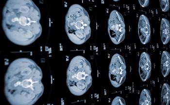 AI Helps to Detect Early Stage Pancreatic Cancer