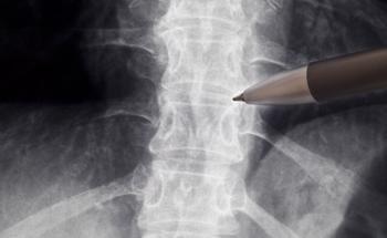 Artificial Intelligence May Help Researchers to Treat Bone Fractures with Better Understanding