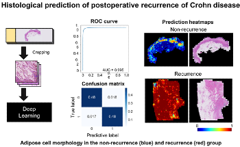Scientists Develop AI Model That Predicts the Recurrence of Crohn's Disease