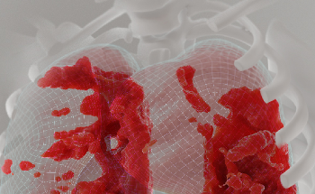 Researchers Develop New AI Tool to Detect Post-COVID Lung Problems