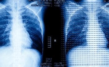 Scientists Shows AI Saving One Hour of Daily Chest CT Interpretation Time