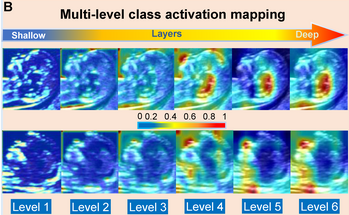 Researchers Utilize AI to Enable Non-Invasive and Precise Screening for Down Syndrome