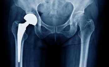 Researchers Begin New Trial Regarding the Use of Robots for Hip Replacement Surgery