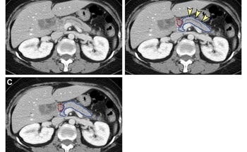 AI Tool Assists Early Diagnosis of Pancreatic Cancer
