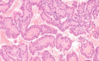 New AI Model Could Aid in the Diagnosis of Rare Diseases