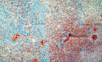 Efficiency of Body’s Defense System in the Diagnosis and Treatment of Skin Cancer Revealed via AI