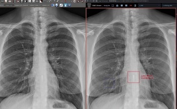 AI Detection of Implanted Electronic Devices for Patient Safety