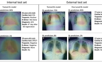 AI May Help Improve Care for Patients with Acute Chest Pain