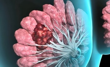AI to Predict the Success of Chemotherapy in Breast Cancer