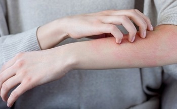 AI Model Detect Complications and Malignant Diseases in Atopic Dermatitis Patients