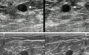 AI Helpful in Triaging Breast Masses in Low-Resource Areas
