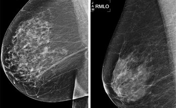 New AI Model Helps Predict Future Cancers