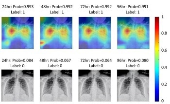 New Deep-Learning Model Helps Determine Severity of COVID-19