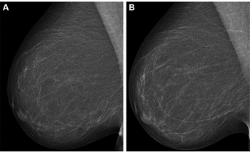 Using AI to Improve Breast Cancer Risk Assessment