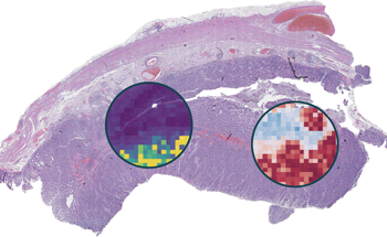 AI Predictions for Effective Precision Oncology