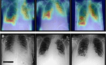 Neural Network Model to Improve Diagnostics Performance on Chest X-Rays