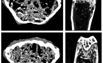 AI Finds Anti-Malarial Drug to be Potential Osteoporosis Treatment