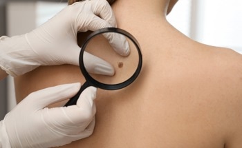 New AI-Powered App Could Improve Early Detection of Skin Cancer