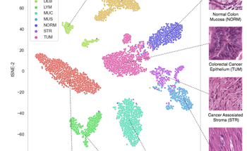 New AI Solution for Colorectal Cancer