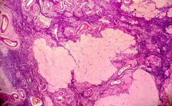 AI Algorithm Sets New Standard in Sarcoma Diagnosis and Treatment