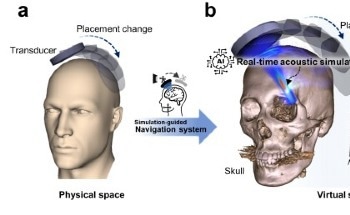 AI Reduces the Obstacles to Treating Ultrasonic Brain Disease
