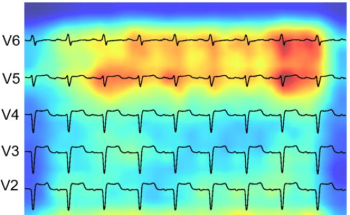 Quantitative Assessment of Right Ventricular Function and Size Based on ECG