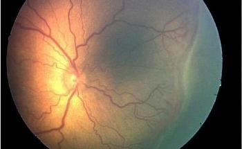 AI Helps Detect Blindness-Causing Condition Affecting Preemies