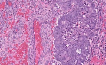 AI Unveils New Layer of Risk in Endometrial Cancer