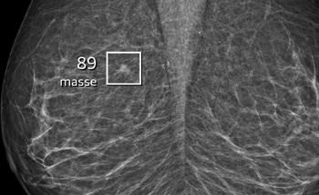 Artificial Intelligence Enhances Breast Cancer Screening Accuracy