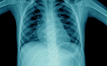 Pneumonia Detection Using Deep Learning