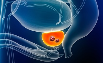 AI Helps Predict Prostate Cancer Without Biopsy