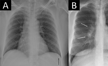 AI-Powered Chest X-Ray Analysis Shows Promise in Clinical Practice
