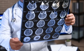 AI Tool Aids in Early Dementia Detection
