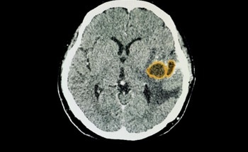 Deep Learning Predicts Sex-Based Survival in High-Grade Gliomas