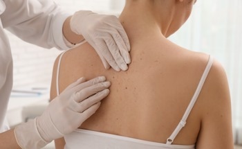 AI-Powered Predictions for Aggressive Skin Cancers
