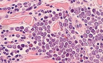 DeepMerkel: A Personalized Prognostic Tool for Merkel Cell Carcinoma
