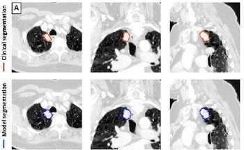 AI Accurately Detects and Segments Lung Cancers
