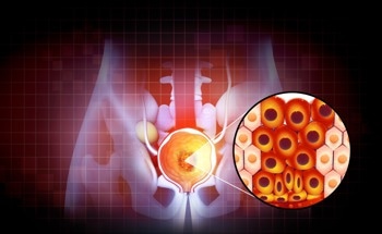 Mount Sinai Performs First HYDROS™ Robotic BPH Procedure