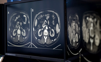 AI Analysis of CT Scans Reveals Early Kidney Damage from Cancer Treatment